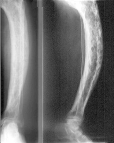 Bệnh Paget xương: chẩn đoán và điều trị