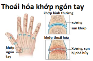 Những điều cần biết về thoái hoá khớp
