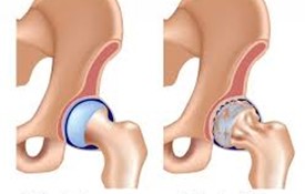 Thoái hoá khớp: Thách thức trong chuẩn đoán và điều trị (phần 1)