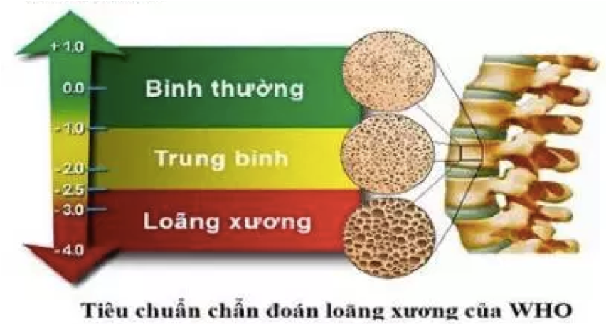 Chẩn đoán loãng xương: Ảnh hưởng của giá trị tham chiếu