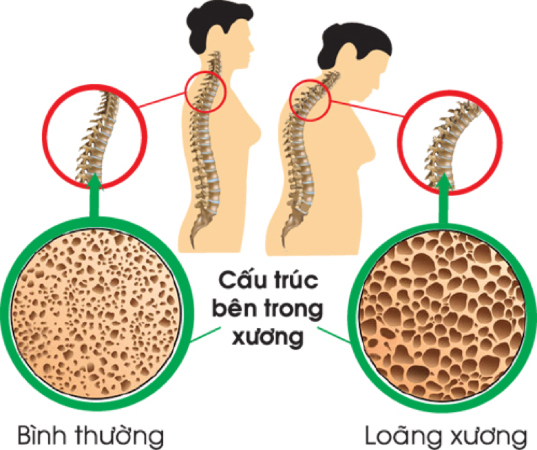 Hướng dẫn dành cho các bậc phụ huynh trong Chăm sóc sức khỏe Xương cho trẻ Phần 1: Sự phát triển xương của trẻ