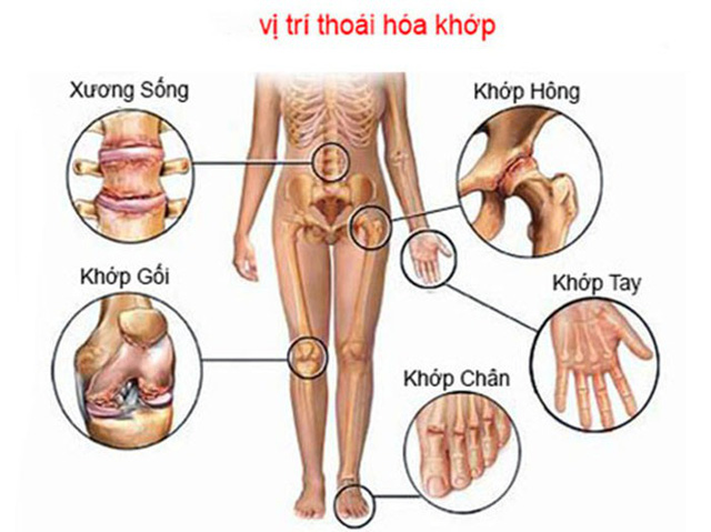 Thoái hoá khớp: Thách thức trong chuẩn đoán và điều trị (phần 2)