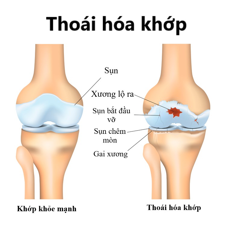 Thoái hoá khớp: Thách thức trong chuẩn đoán và điều trị (phần 3)