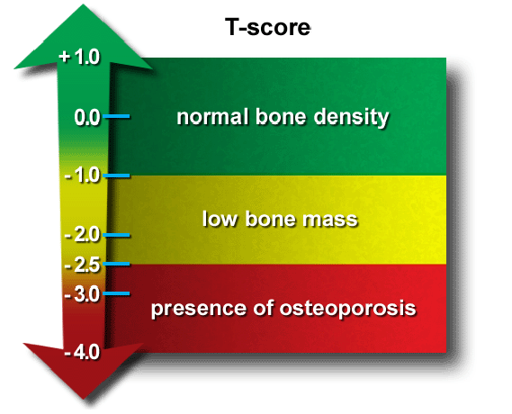 Làm thế nào để chẩn đoán loãng xương 
