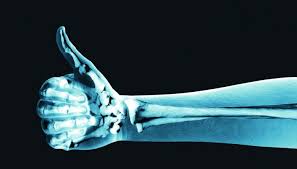 Loãng Xương: nhìn lại hành trình 5 năm (Phần 2)