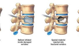Hiệu quả của bơm xi măng trong điều trị gãy xương cột sống
