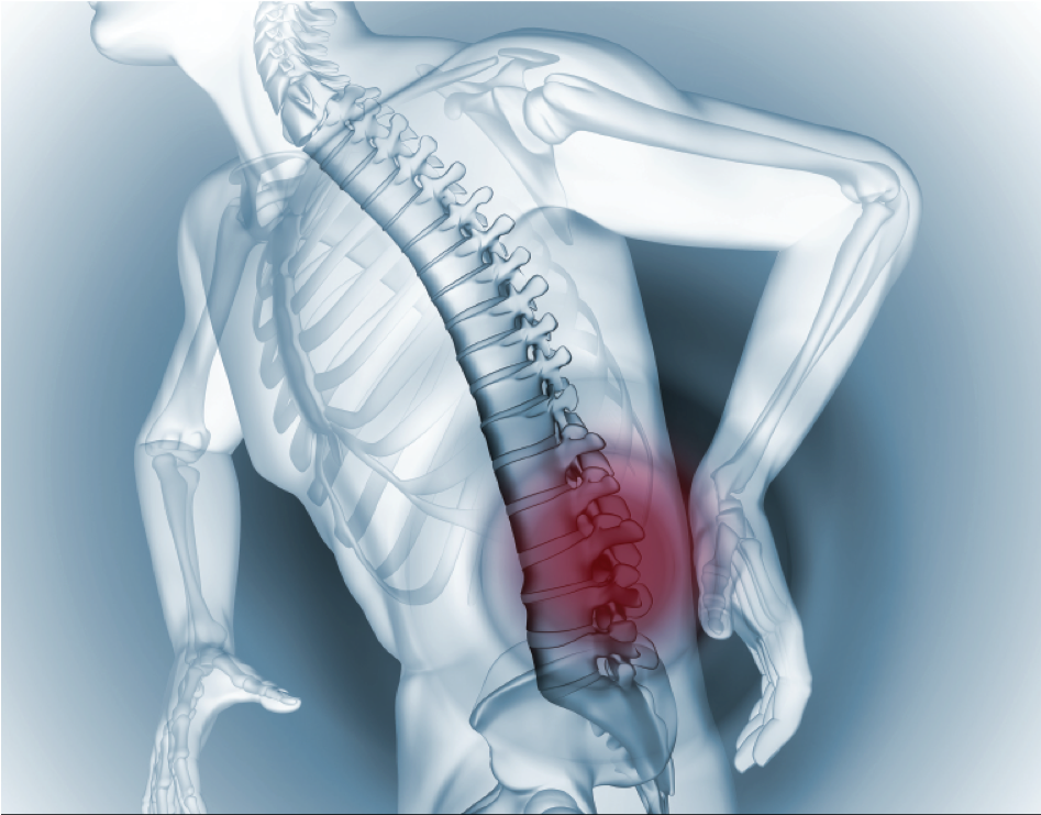 Gãy xương cột sống do loãng xương