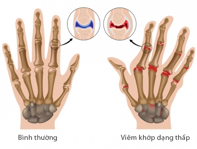 7 điều cần biết về bệnh lý cơ xương khớp