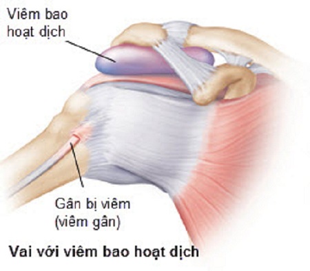 Đau vai: chẩn đoán và điều trị