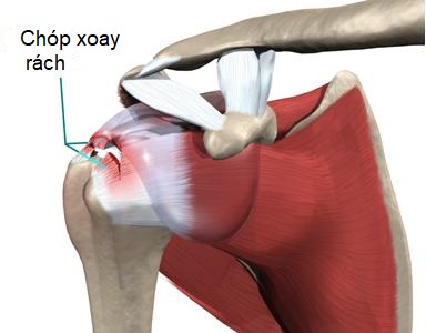 Đau vai: chẩn đoán và điều trị