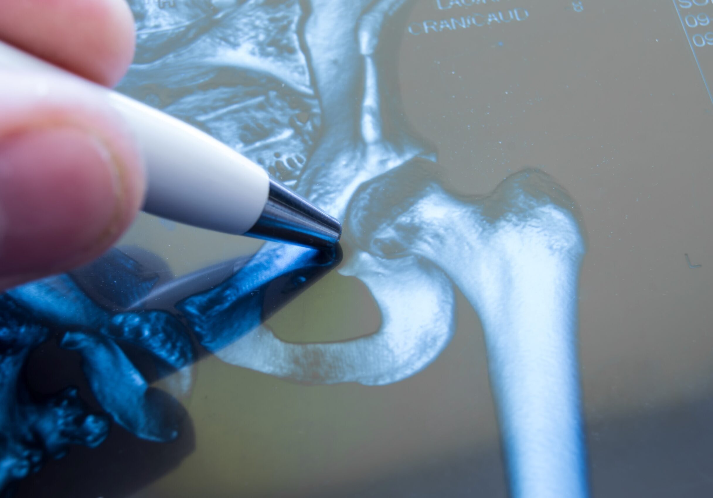 Tử vong từ một đường gãy: hiểu mối liên hệ giữa gãy xương do loãng xương và tỉ lệ tử vong.